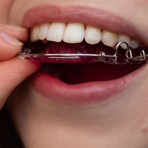 Retainer in Tagalog .